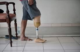 Pemkab PPU Anggarkan Rp150 Juta untuk Bantuan Kaki Palsu bagi Penyandang Disabilitas